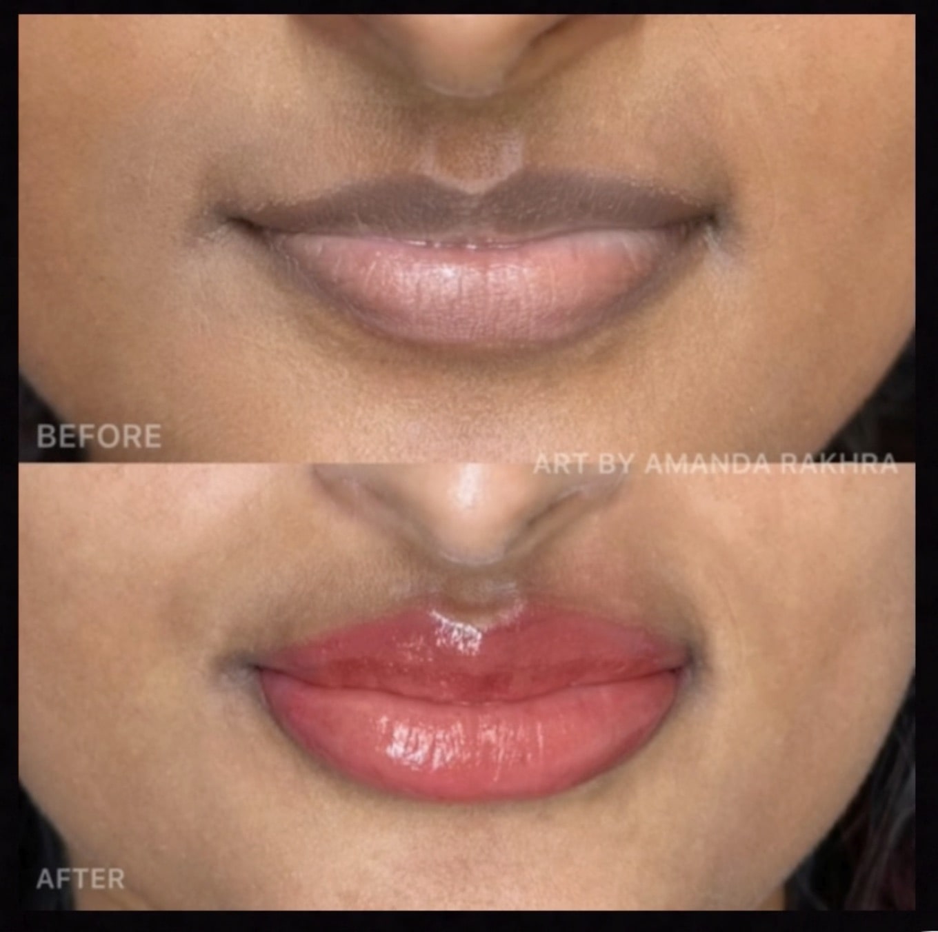 Fitz 5 Dark Lip Neutralization: Anita's Case Study by Amanda Rakhra