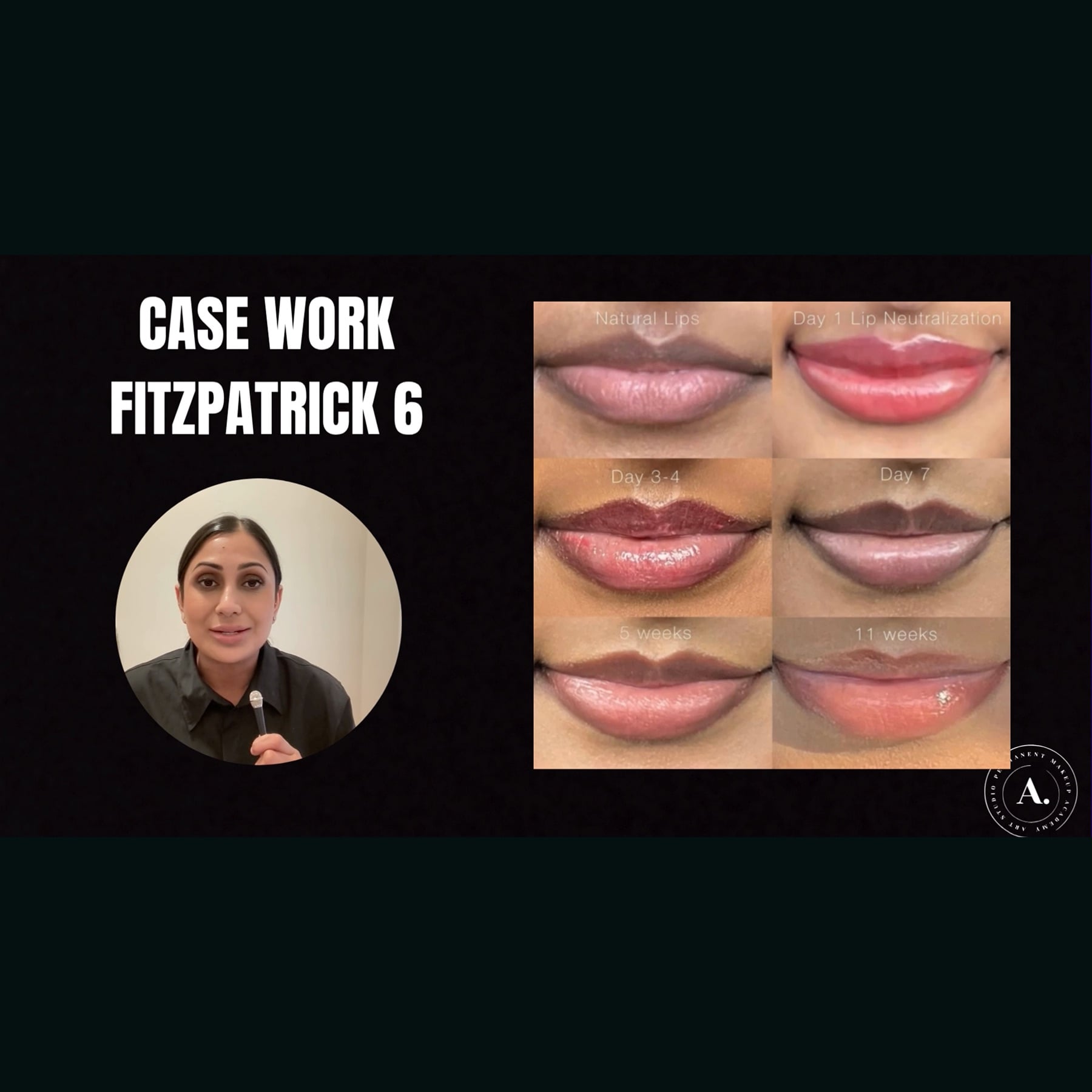 Fitz 5 Dark Lip Neutralization: Anita's Case Study by Amanda Rakhra