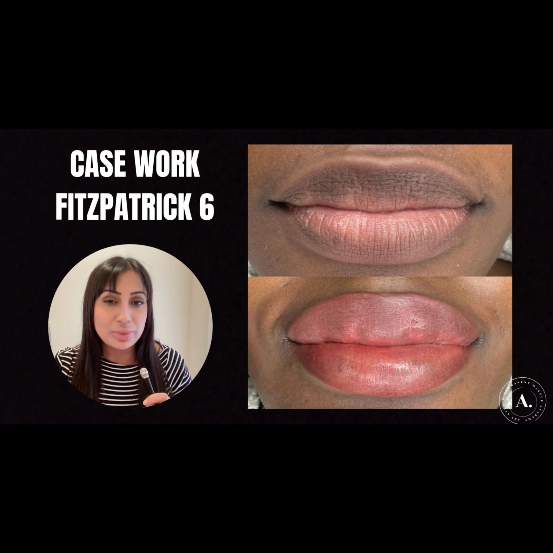 Fitz 6 Dark Lip Neutralization: Kurty’s Case Study