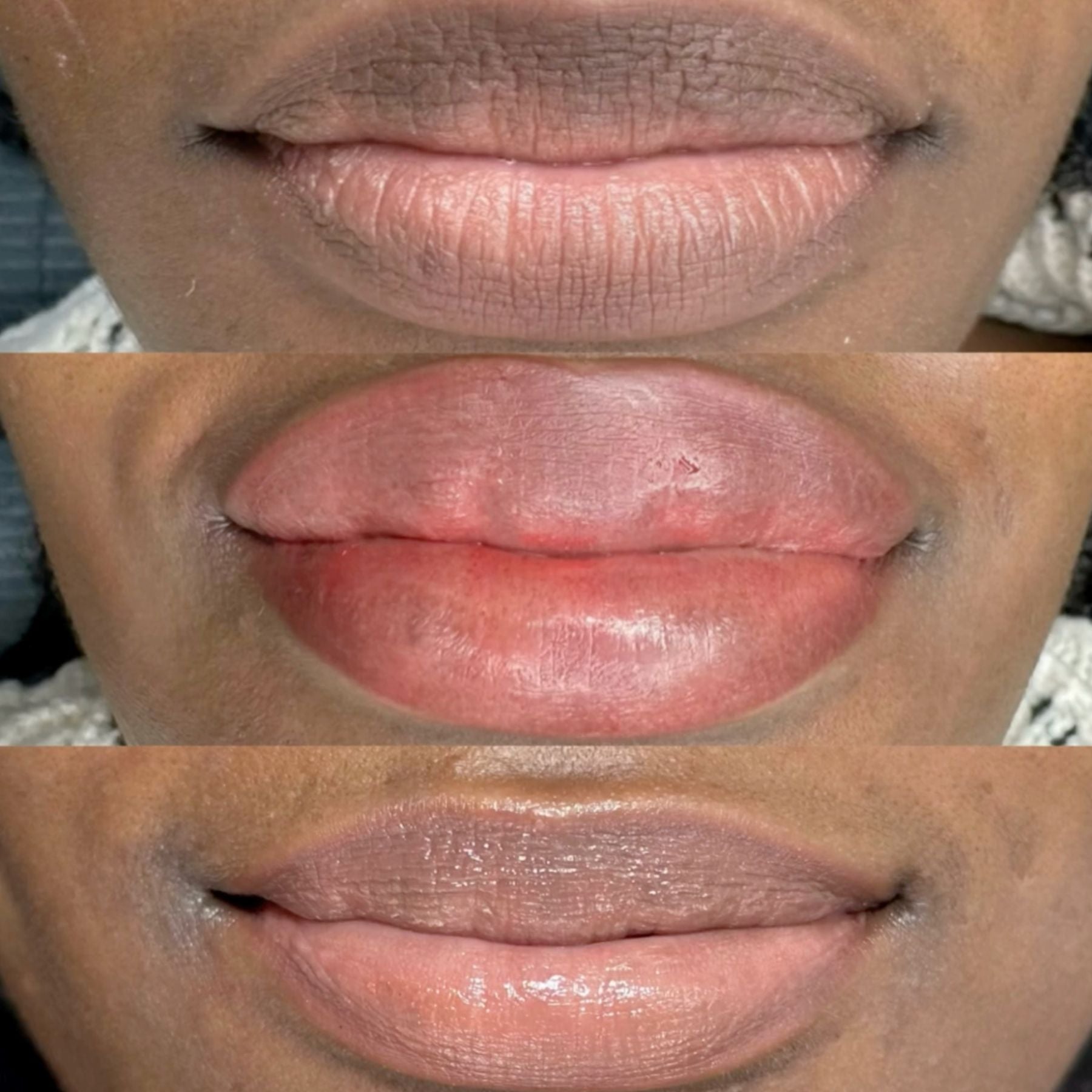 Fitz 6 Dark Lip Neutralization: Kurty’s Case Study