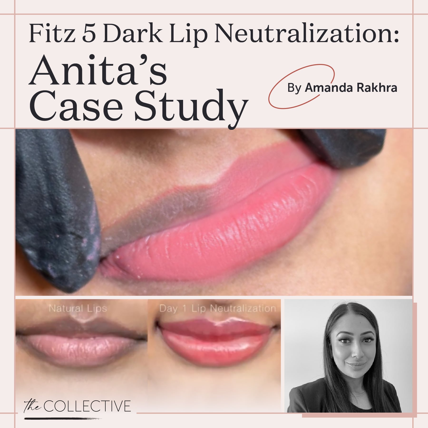 Fitz 5 Dark Lip Neutralization: Anita's Case Study by Amanda Rakhra